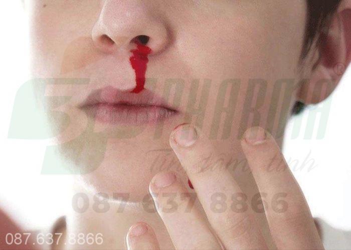 Chảy máu cam diễn ra nhiều lần trong ngày, chảy máu cam nhiều lần trong ngày nên làm gì