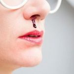 Chảy máu cam nếu xảy ra thường xuyên thì bạn cần đi khám và có hướng điều trị