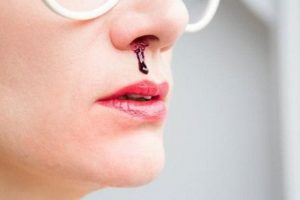 Chảy máu cam nếu xảy ra thường xuyên thì bạn cần đi khám và có hướng điều trị