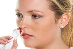 Tình trạng chảy máu cam ở người lớn là bệnh gì?