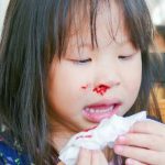 Chảy máu cam do khô mũi