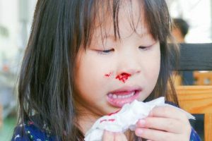 Chảy máu cam do khô mũi