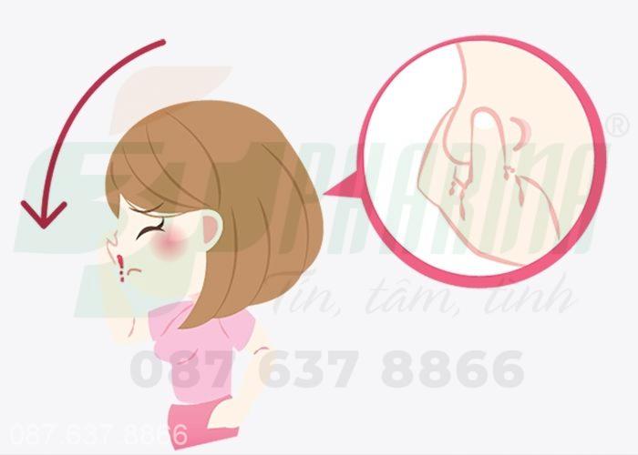 Điều trị chảy máu cam