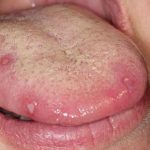 Dấu hiệu nhiệt lưỡi có phải lời cảnh báo về một bệnh lý nào không?
