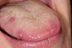 Dấu hiệu nhiệt lưỡi có phải lời cảnh báo về một bệnh lý nào không?