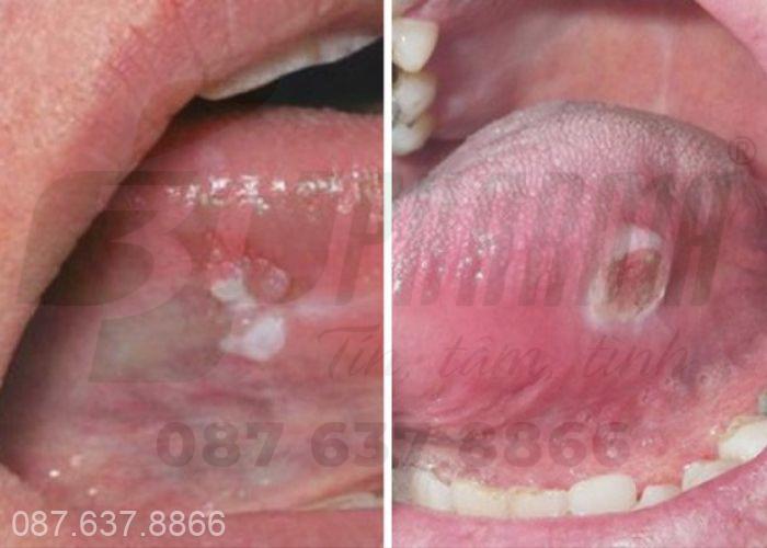 Nhiệt lưỡi có thể xuất hiện ở các vị trí đầu lưỡi, 2 bên lưỡi 