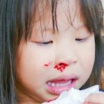 Chảy máu cam khiến nhiều người lo lắng