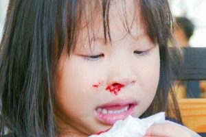 Chảy máu cam khiến nhiều người lo lắng