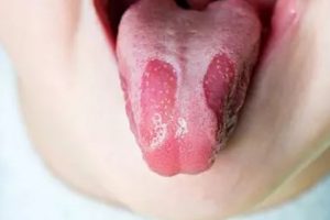 Nguyên nhân nhiệt lưỡi là gì? Hướng dẫn cách điều trị hiệu quả