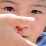 Nguyên nhân trẻ bị chảy máu cam