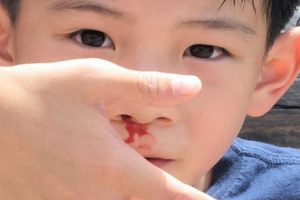 Nguyên nhân trẻ bị chảy máu cam