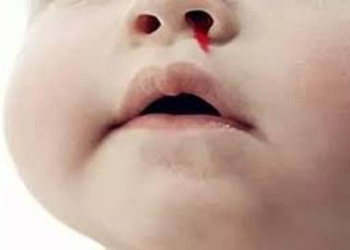 Nguyên nhân nằm điều hòa bị chảy máu cam là gì?