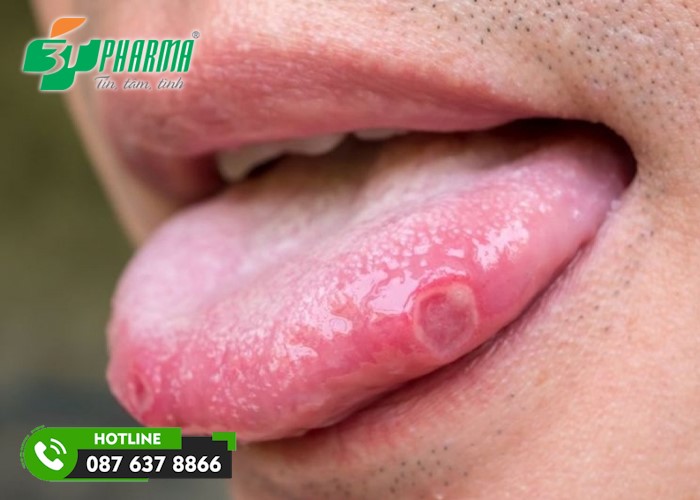Hình ảnh nhiệt lưỡi 1 - 3Tpharma