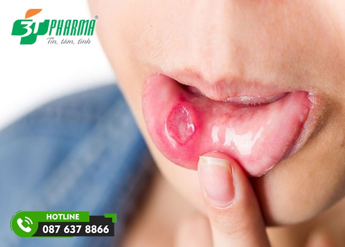 Hình ảnh nhiệt lưỡi 2 - 3Tpharma