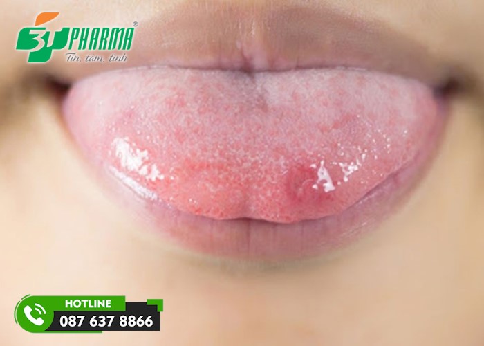 Hình ảnh nhiệt lưỡi 3 - 3Tpharma