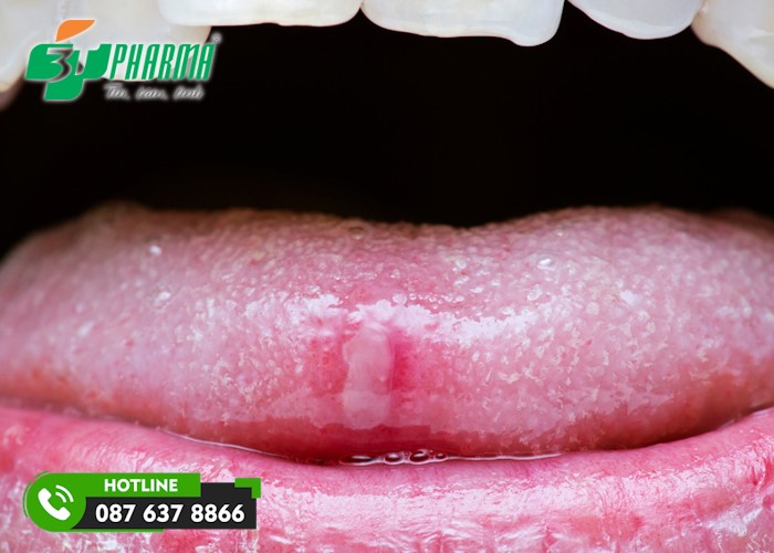 Hình ảnh nhiệt lưỡi 5 - 3Tpharma