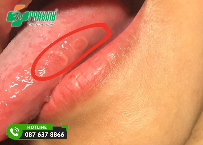 Hình ảnh nhiệt lưỡi 6 - 3Tpharma