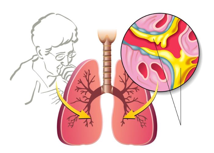 Ho có đờm là triệu chứng đặc trưng khi bị viêm phế quản cấp