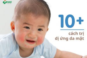 cách trị dị ứng da mặt