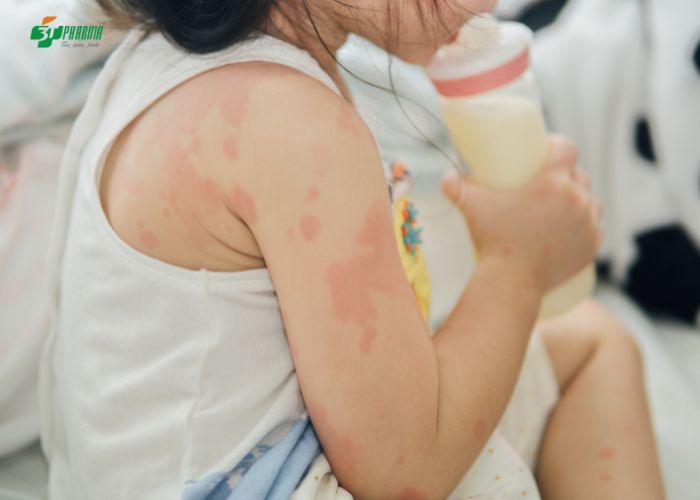 Sữa (dị ứng đạm sữa bò, dị ứng sữa công thức, sữa đậu nành)