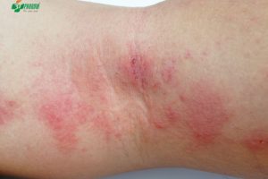Dị ứng ngoài da là một trong những dạng dị ứng phổ biến, nhiều người mắc