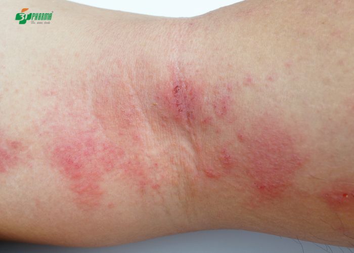 Dị ứng ngoài da là một trong những dạng dị ứng phổ biến, nhiều người mắc