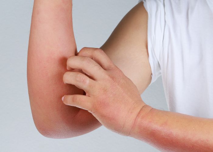 Da sưng đỏ, ngứa ngáy là biểu hiện của dị ứng mỹ phẩm phổ biến