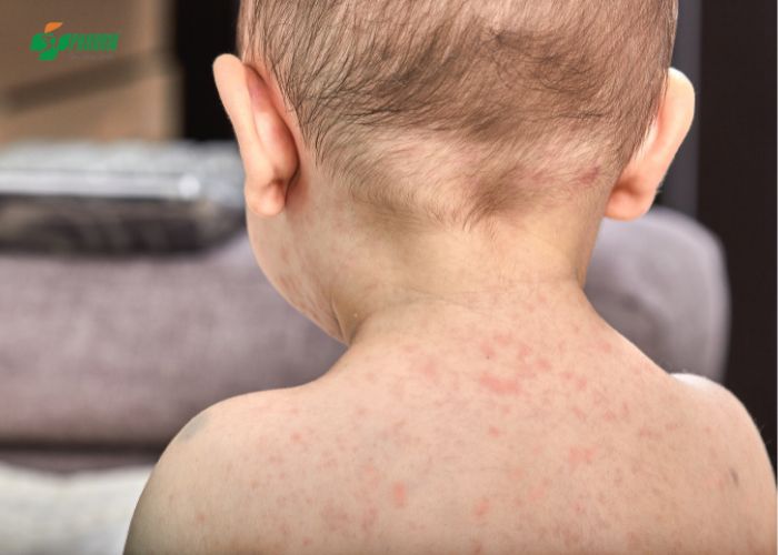 Mẩn ngứa da là triệu chứng phổ biến nhất khi bị dị ứng cơ địa