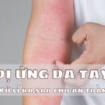 dị ứng da tay