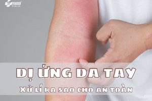 dị ứng da tay