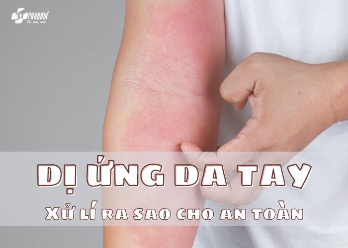 dị ứng da tay