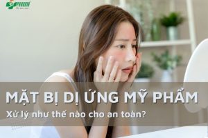 dị ứng mỹ phẩm