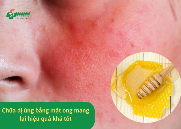 Chữa dị ứng bằng mật ong mang lại hiệu quả khá tốt