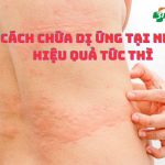 10 cách chữa dị ứng tại nhà, hiệu quả, khỏi nhanh
