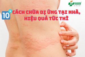 10 cách chữa dị ứng tại nhà, hiệu quả, khỏi nhanh