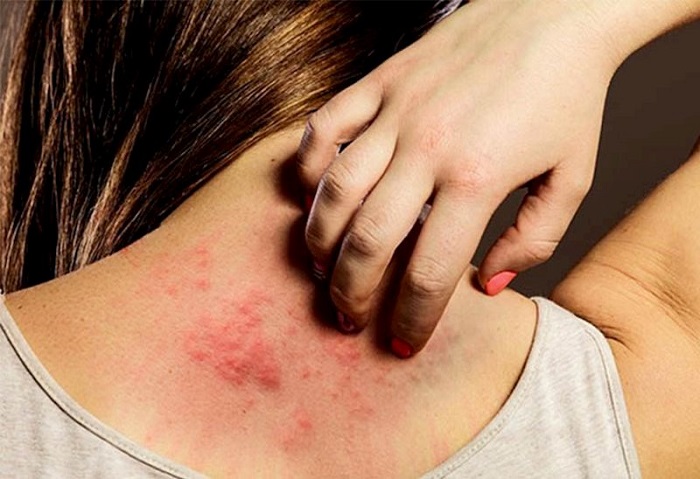 Mẩn ngứa, dị ứng sau khi sinh là tình trạng khá phổ biến