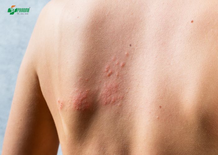 Mề đay cấp tính là dấu hiệu dị ứng thời tiết vô cùng khó chịu
