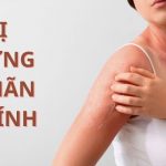 dị ứng mãn tính