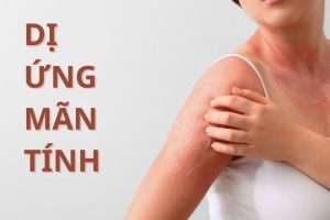 dị ứng mãn tính