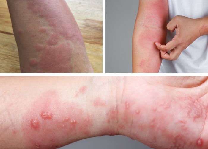 Mẩn đỏ, mề đay, ngứa ngáy trên da là triệu chứng phổ biến
