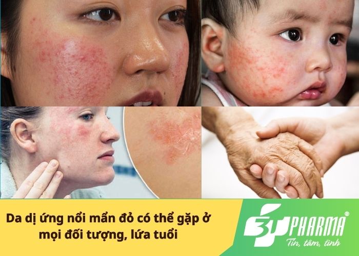 Da dị ứng nổi mẩn đỏ có thể gặp ở mọi đối tượng, lứa tuổi