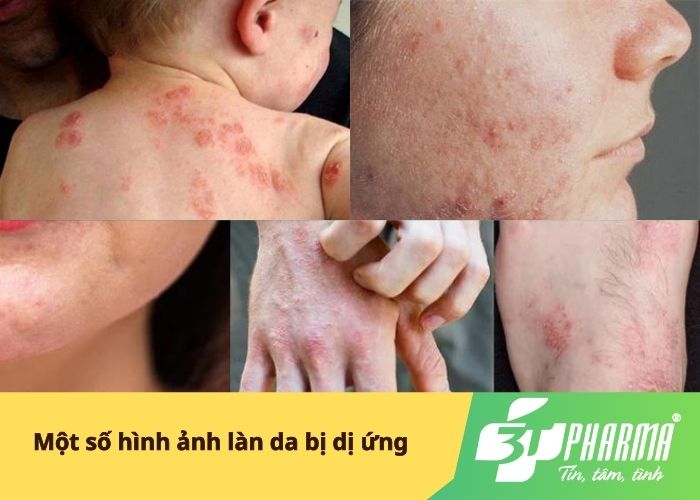 Một số hình ảnh làn da bị dị ứng
