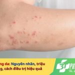 Nguyên nhân bị dị ứng da và cách điều trị hiệu quả