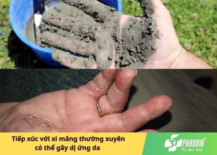 Tiếp xúc với xi măng thường xuyên có thể gây dị ứng da 