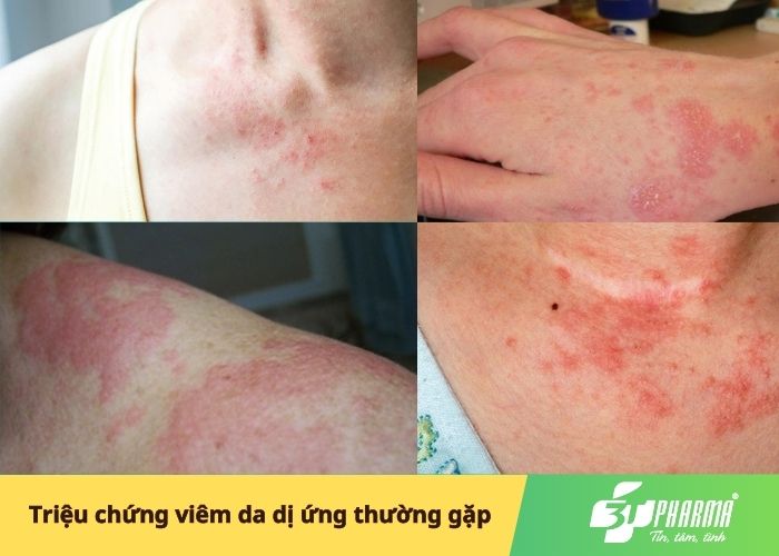 Triệu chứng viêm da dị ứng thường gặp