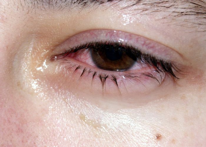 Viêm kết mạc dị ứng có thể khiến mắt sưng nề, khó mở mắt khi thức dậy