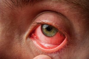 Viêm kết mạc dị ứng