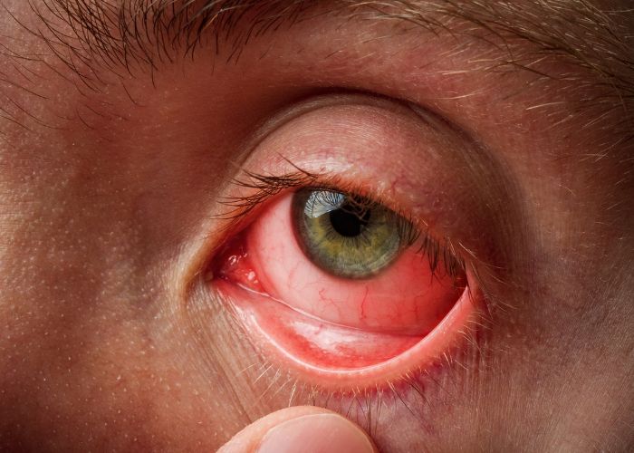 Viêm kết mạc dị ứng khiến mắt sưng đỏ, đau rát khó chịu