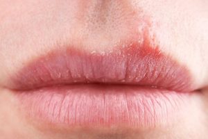 viêm môi dị ứng