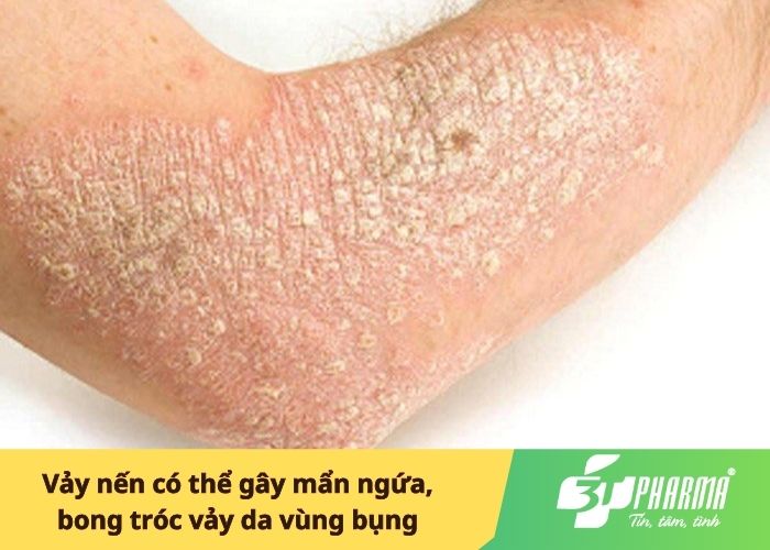 Vảy nến có thể gây mẩn ngứa, bong tróc vảy da vùng bụng